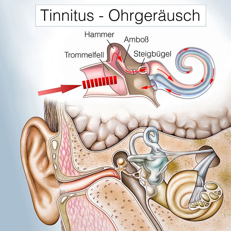So entsteht ein Tinnitus